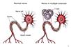Po lewej stronie model neuronu uszkodzonego przez SM
