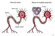 Po lewej stronie model neuronu uszkodzonego przez SM Po lewej stronie model neuronu uszkodzonego przez SM